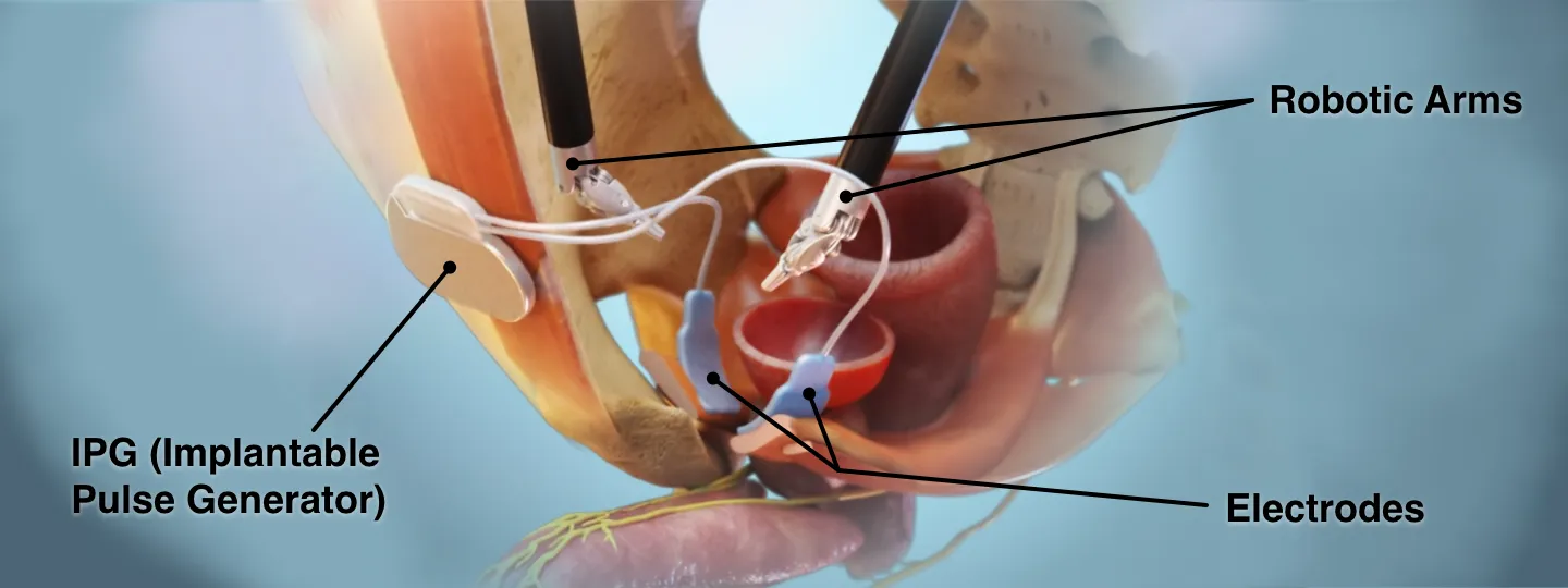 Robotic-assisted surgical arm with CaverSTIM's implantable components labeled